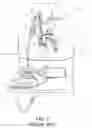 Fig. 02 - DUAL LUMEN DRAINAGE CANNULA WITH SINGLE OUTLET