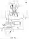 Fig. 11 - DUAL LUMEN DRAINAGE CANNULA WITH SINGLE OUTLET