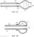 Fig. 03 - METHODS AND DEVICES FOR PASSIVE RESIDUAL LUNG VOLUME REDUCTION AND FUNCTIONAL LUNG VOLUME EXPANSION