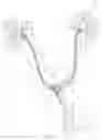 Fig. 13 - Coated Urinary Catheter or Ureteral Stent and Method