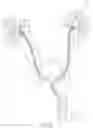 Fig. 19 - Coated Urinary Catheter or Ureteral Stent and Method