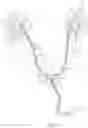 Fig. 39 - Coated Urinary Catheter or Ureteral Stent and Method