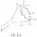 Fig. 46 - Coated Urinary Catheter or Ureteral Stent and Method