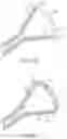 Fig. 47 - Coated Urinary Catheter or Ureteral Stent and Method