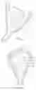 Fig. 55 - Coated Urinary Catheter or Ureteral Stent and Method