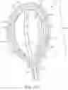 Fig. 65 - Coated Urinary Catheter or Ureteral Stent and Method
