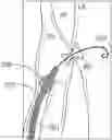Fig. 01 - Systems for delivering implantable devices across an atrial septum