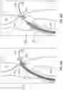 Fig. 67 - Systems for delivering implantable devices across an atrial septum