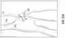 Fig. 69 - Systems for delivering implantable devices across an atrial septum