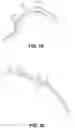 Fig. 15 - Endoscopic balloon dilator systems