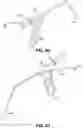 Fig. 45 - Endoscopic balloon dilator systems