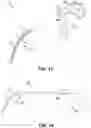 Fig. 12 - Endoscopic balloon dilator systems