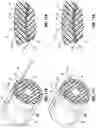 Fig. 13 - VASCULAR ACCESS SHEATH AND CATHETER SYSTEM