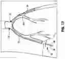 Fig. 20 - VASCULAR ACCESS SHEATH AND CATHETER SYSTEM