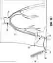 Fig. 21 - VASCULAR ACCESS SHEATH AND CATHETER SYSTEM
