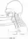 Fig. 02 - Eliciting Swallowing using Electrical Stimulation Applied via Surface Electrodes
