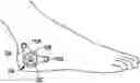 Fig. 01 - High frequency electrostimulation treatment for restless legs syndrome or periodic limb movement disorder
