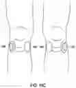 Fig. 19 - High frequency electrostimulation treatment for restless legs syndrome or periodic limb movement disorder