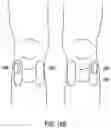 Fig. 21 - High frequency electrostimulation treatment for restless legs syndrome or periodic limb movement disorder