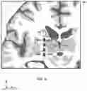 Fig. 09 - Programming rank index for electrical stimulation and recording