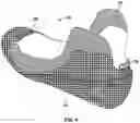 Fig. 04 - Skate with injected boot form