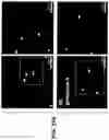 Fig. 78 - METHODS FOR DIAGNOSING AND TREATING INFLAMMATORY BOWEL DISEASE