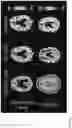 Fig. 33 - DIFFUSION DICTIONARY IMAGING (DDI) OF MICROSTRUCTURE AND INFLAMMATION
