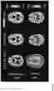 Fig. 34 - DIFFUSION DICTIONARY IMAGING (DDI) OF MICROSTRUCTURE AND INFLAMMATION