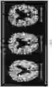 Fig. 36 - DIFFUSION DICTIONARY IMAGING (DDI) OF MICROSTRUCTURE AND INFLAMMATION