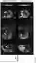Fig. 43 - DIFFUSION DICTIONARY IMAGING (DDI) OF MICROSTRUCTURE AND INFLAMMATION