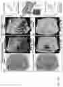 Fig. 48 - DIFFUSION DICTIONARY IMAGING (DDI) OF MICROSTRUCTURE AND INFLAMMATION
