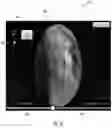 Fig. 06 - SYSTEM AND METHOD FOR IDENTIFYING, MARKING AND NAVIGATING TO A TARGET USING REAL TIME TWO DIMENSIONAL FLUOROSCOPIC DATA