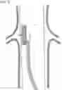 Fig. 12 - Endovascular orifice detection device for accurate fenestrated stent graft deployment