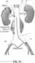 Fig. 14 - Endovascular orifice detection device for accurate fenestrated stent graft deployment
