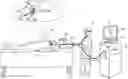 Fig. 01 - Annotation of late potentials comprising local abnormal ventricular activation (LAVA) signals