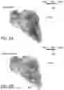 Fig. 05 - Annotation of late potentials comprising local abnormal ventricular activation (LAVA) signals