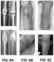 Fig. 05 - METHOD OF TREATING AND PREVENTING BONE AND JOINT INFECTIONS