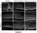 Fig. 12 - GENE THERAPY FOR TREATING OR PREVENTING VISUAL EFFECTS IN BATTEN DISEASE