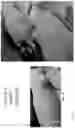 Fig. 35 - METHOD FOR ENHANCING TUMOR GROWTH