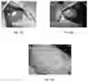 Fig. 07 - Bleeding Detection Method
