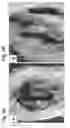 Fig. 03 - Cartilage Regeneration Using Chondrocyte And TGF-Beta