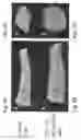 Fig. 08 - Cartilage Regeneration Using Chondrocyte And TGF-Beta