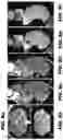 Fig. 12 - Systems and methods for opening of a tissue barrier in primates