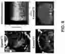 Fig. 13 - Systems and methods for opening of a tissue barrier in primates