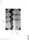 Fig. 06 - Automatic reduction of the appearance of Mach band effect on radiographs