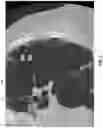 Fig. 06 - Systems and methods for detection and staging of pulmonary fibrosis from image-acquired data