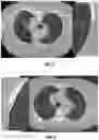 Fig. 09 - Systems and methods for detection and staging of pulmonary fibrosis from image-acquired data