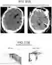 Fig. 33 - Methods and kits for assessing central nervous system integrity
