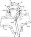 Fig. 01 - SEMISPHERICAL BRAIDED ANEURYSM TREATMENT SYSTEM AND METHOD