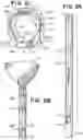 Fig. 03 - SEMISPHERICAL BRAIDED ANEURYSM TREATMENT SYSTEM AND METHOD